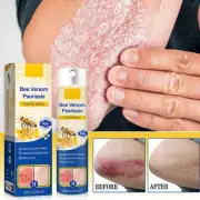 5PCS Bee Venom Psoriasis Care Spray pro Anti-itching Psoriasis Treatment Spray