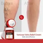 Removal Varicose Veins Treatment Cream Anti-Spider Stretch Marks Vasculitis