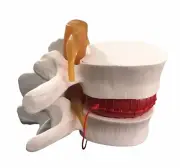 Enlarged Human Anatomical Lumbar Vertebrae with Herniated Disk Teaching Model US