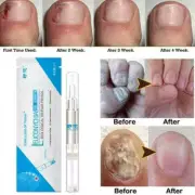 Fungal Nail Treatment Liquid Pen Nail Finger Toe Repair M7R2 Remover. P1T1