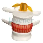 Human Lumbar Model Anatomical Disc Herniation Medical Learn Aid Instrume Teach