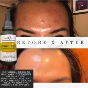NATURASHEEN PORELESS CLEARING SERUM For acne, Dark Spots, Fine Line Wrinkle