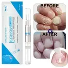 FUNGUS STOP Pencil - Anti Fungal Nails Repair Treatment Fingernails ⭐{ ζы ыλ