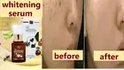 Scar Silicone gel whitening brightening skin care keloid lightening dark spot