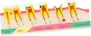 Alipis Teeth Model Educational Oral Demonstration Tool for Patient Explanations Pathological Tooth Representation for Studies and Teaching