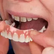 Extra Thin Fake Bright White Tooth Veneers Silicone Soft Safe Adhesive Denture Hide Shade Braces Comfortable Teeth Orthodontic Dvm