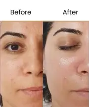 Intimate Skin Lightening -Glutathione Gummies