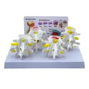 Lumbar Vertebrae Anatomy Model Nursing Model 4 Stages Lesions Comparative Model