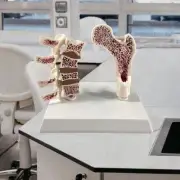 Human Femur Osteoporosis Anatomy Model Skeleton Display Educational Tool