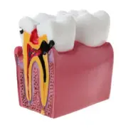 Dental Caries Comparation Anatomy Teeth Model for Dental Anatomy Lab Tea