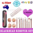 Blackhead Black Head Extractor Remover Tools Pimple Comedone Acne Clip 4Pcs Set