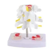 Anatomical Lumbar Disc Herniation Demonstration Model Human Spine School Tra NEY
