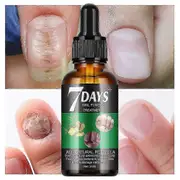 7 Days Nail Fungus Treatment, 7 Days Nail Growth and Strengthening Serum Nail, Nail Repair Solution, 1pcs