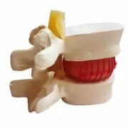 PVC Spine Model 1:1.5 For Lumbar Disc Herniation Medical Education