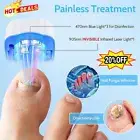 Nail Fungus Laser-Device Light Therapy Onychomycosis Toes Treatment Home Hot J9