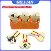 4 Times Caries Comparation Models Dental Detachable Abutment Teach Study Model