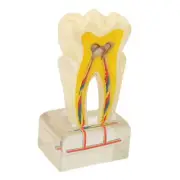 Dental Caries Model Acrylic 6 Times Decayed Tooth Model Dental Education ADS
