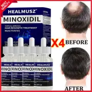 4X Minoxidil 5% Extra Strength Men Hair Regrowth Topical Solution 4 Month Supply