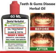 EXTRA FRESH TOOTH GUM DISEASE TREATMENT OIL TEETH BAD BREATH - Herbal Oil 60 ML