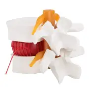 1:1.5 Human Herniated Disc Model, Anatomical Prolapse Model