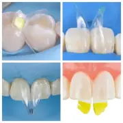 Clear Matrix Dental Anterior Matrices Posterior Class II Fit BioClear Fit Biofit