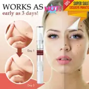 3ML Face Plantar Moles-Off Remover, WipeOff Tags & Moles Remover Safe