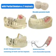 Dental Typodont M6022 Restoration Model with Partial Denture, 2 Implants