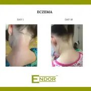 Eczema and Psoriasis Cream, effective and safe for children