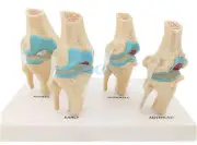 Anatomical Human Degenerative Knee Joint Disease Model Skeleton Anatomy Teach