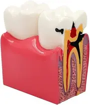 1pc Dental Teeth Model 6 Times Caries Comparation Study Models for Dentist Stomatology Education Researching Materials Lab Tool