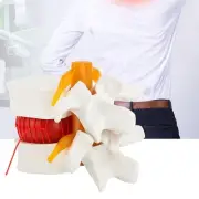 Lumbar Spine Model Medical Study Tool Human Disc Herniation 1to1.5 Scale