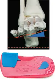 Vasyli Forefoot Varus Wedge | Plantar Fascia & Foot Pain Treatment | Physio Recd