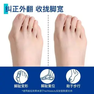 【台灣公司保固】科靚新款大拇指外翻器可調節帶旋鈕腳趾矯正器成人腳趾外翻矯正器
