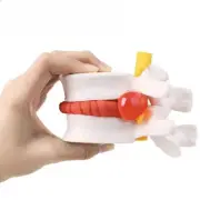 Anatomical Spine Lumbar Disc Herniation Model Medical Props Model Anatomy Tool