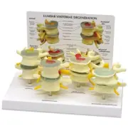 Lumbar Vertebrae Osteoporosis GPI Anat Set LFA #1760.Make Us an Offer! SEE VIDEO