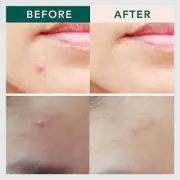 6 Patches Tiny needle Acne Pimple Healing Patch Anti Acne Pimple Patch Soothi CR