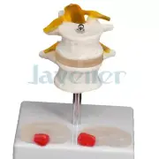 Human Two Lumbar Lesions Intervertebral Disc Skeleton Spine Model Medical Learn