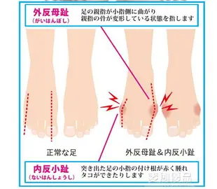 日本腳趾矯正器大拇指外翻矯正器腳趾重疊瑜伽分趾器足外翻矯正器 「優品居家百貨」