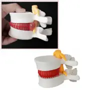 1Pcs Dental Medical Demonstration Model Spine Lumbar Disc Herniation Model AU