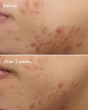 Murad Deep Relief Blemish Treatment 30ml
