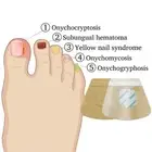 Anti Fungal Nail Treatment Patches Finger Toe Fungus Onychomycosis Repair _ga
