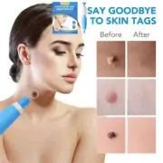 2 In1 Painless Auto Skin Tag Mole Removal Kit Cleaning Tools Face Skin Care Body