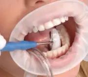 100 Pcs Disposable Dental Sterile Rubber Retractor Lip Cheek Mouth Opener White