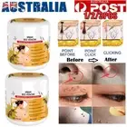 Bee Venom Skin Tag Removal Treatment Cream For Body Care Mole Corn Skins Wart AU