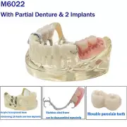Dental M6022 Typodont Implant Restoration Teeth Model with Partial Dentures