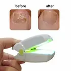 Treat Nail Fungus LLLT Laser Therapy Device Anti Fungal Cure Grey Toenail NEW