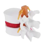 1:1.5 Human Lumbar Disc Herniation Demonstration Model of Lumbar Vertebral2116