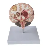 Human Brain Disease Model - Brain Pathology Brainstem Hemorrhage Medical1472