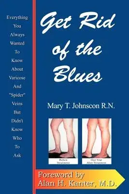 Get Rid of the Blues: Everything You Always Wanted to Know About Varicose & ”Spider” Veins but Didn’t Know Who to Ask
