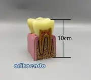 Dental Disease Anatomy Education Teeth Model Caries Comparation Model For Study